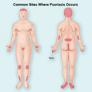 psoriasis common sites on body