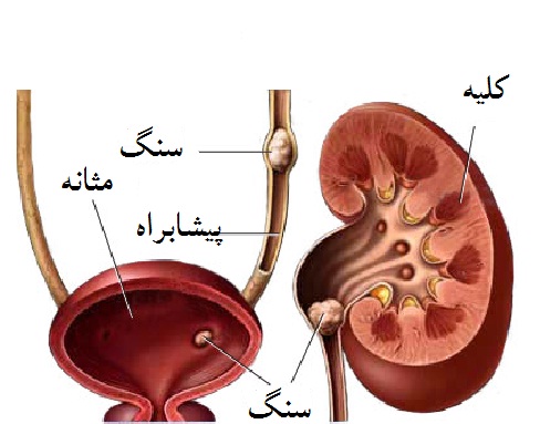 image of kidney stones